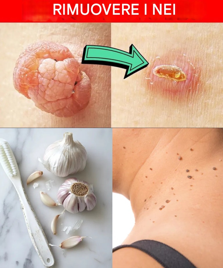 Le verruche plantari e le escrescenze cutanee scompaiono naturalmente: prova questo rimedio notturno