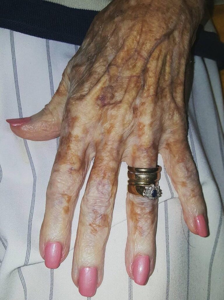 Un’infermiera fotografa la mano di una donna anziana… e ciò che scopre sconvolge il web. Guarda i commenti qui sotto 👇🏻👀