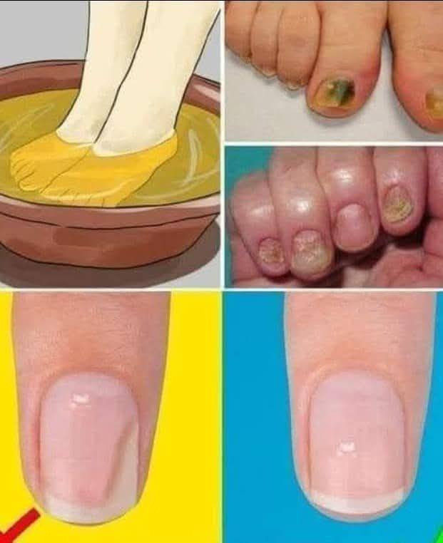 Chiamato « Fungus Buster »: elimina i funghi alle unghie e i calli dei piedi in una sola passata
